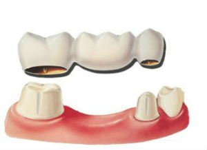 Dental Bridges | Richmond Dental Care | San Francisco, CA Dentist