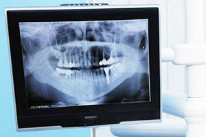 Dental X-Rays | Richmond Dental Care | San Francisco, CA Dentist